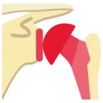 Frozen Shoulder treatment