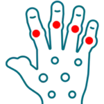 Rheumatoid arthritis treatment