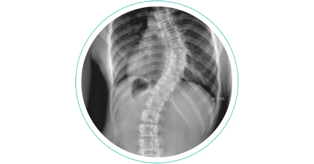 scoliosis disease